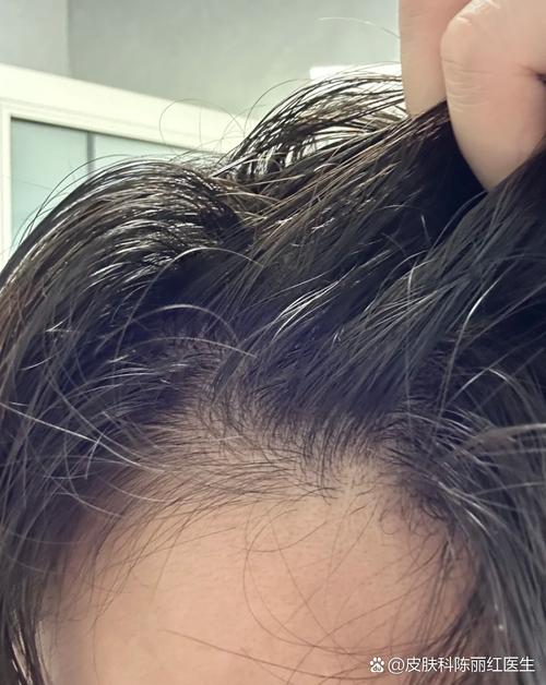 跑完800头发会油吗_运动后头发油腻？这样洗护更清爽！