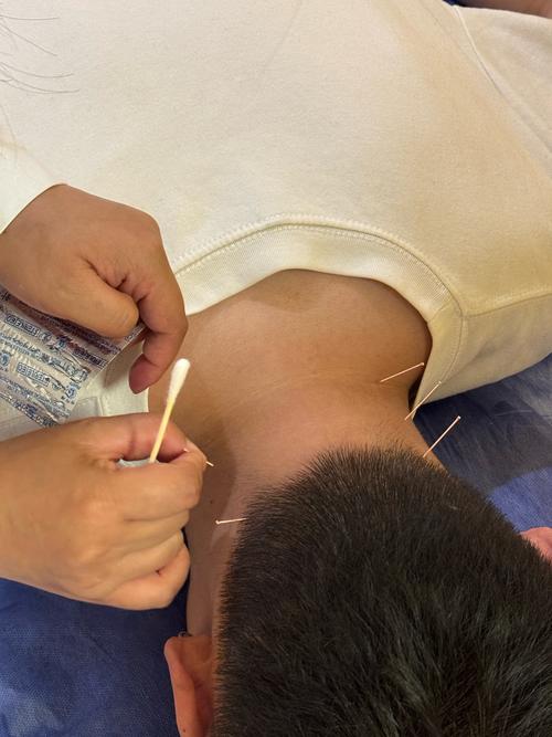 针炙拿针的正确方法_提捏进针二指持针毫针使用