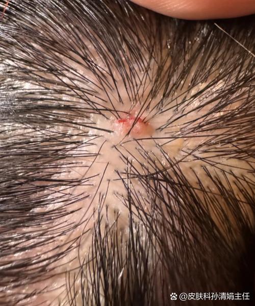 触碰头发根头皮就很痛_头皮痛?烫染太猛发型太紧都可能导致! 触碰头发根头皮就很痛_头皮痛?烫染太猛发型太紧都可能导致!