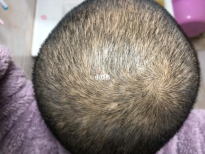 毛囊坏死了还能长出新头发吗_真假之分与修复保养 毛囊坏死了还能长出新头发吗_真假之分与修复保养