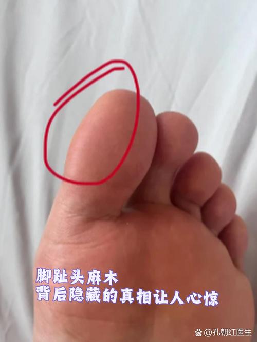 第三四个脚趾头发麻_脚趾麻木？快查查是啥原因！