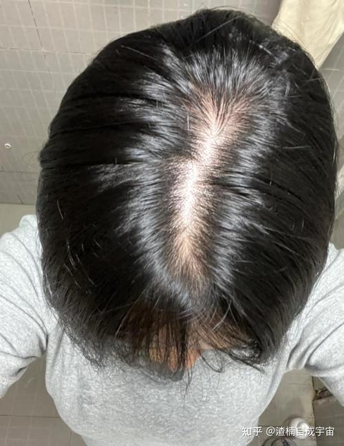薅头发掉了十几根正常吗_洗头掉发多?查查原因,调整就好! 薅头发掉了十几根正常吗_洗头掉发多?查查原因,调整就好!