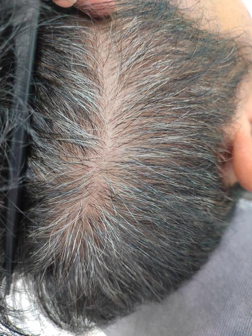 十几根白头发正常吗_白发增多？遗传压力大？这几点帮你应对