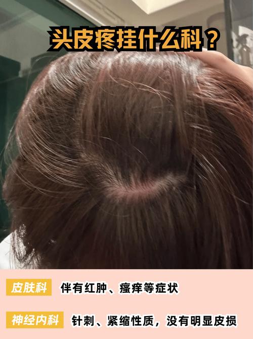一动头发头皮就扯着痛_头皮一动就疼？快查查原因！
