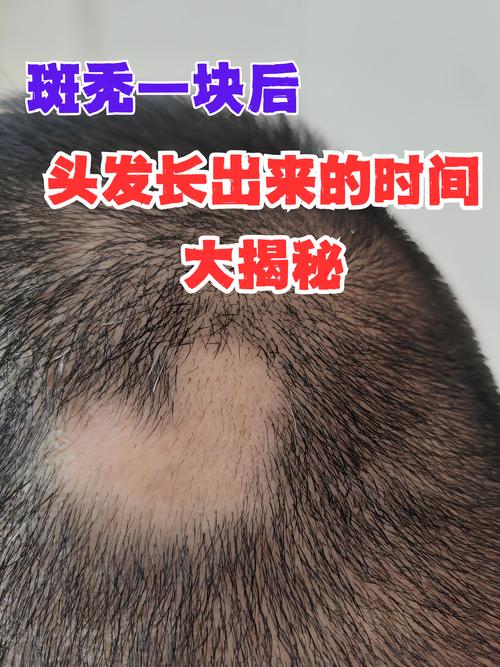 秃斑是没头发还是看着少就是秃斑_斑秃秃斑治疗与预防 秃斑是没头发还是看着少就是秃斑_斑秃秃斑治疗与预防
