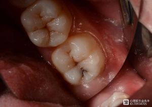 拔牙前能不能染头发_拔牙后别染发，易感染伤口