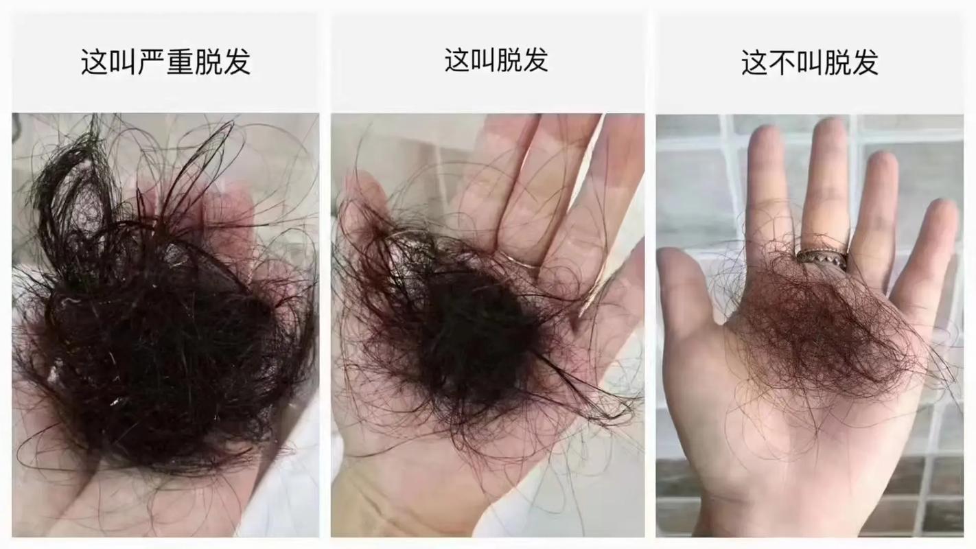 捋一下头发掉几根算脱发_脱发超100根要当心，注意生活习惯和就医