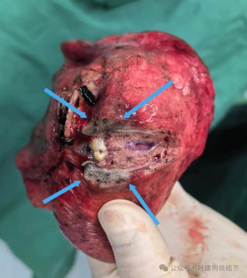 结节手术前能染头发吗_结节手术前慎染发,一周内别碰! 结节手术前能染头发吗_结节手术前慎染发,一周内别碰!