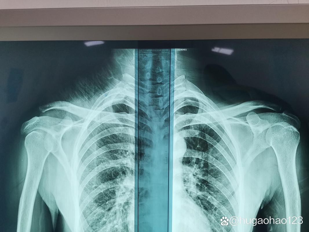 拍肩关节正位片什么姿势_肩正位片拍姿要标准，侧位片患侧紧贴
