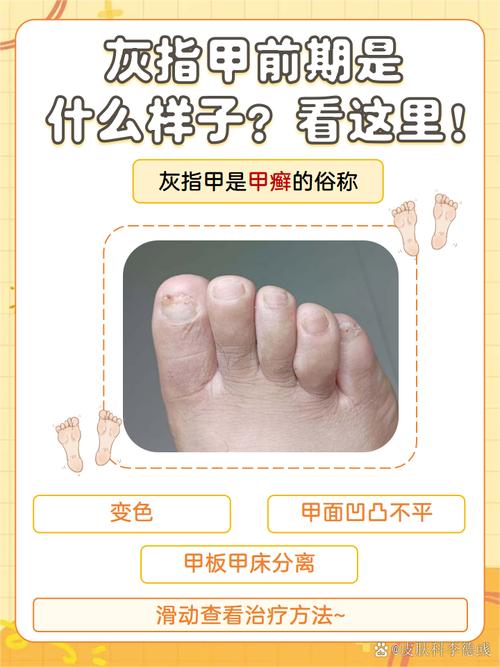 灰指甲是什么颜色_灰指甲颜色多样,从白到黑,防患于未然是关键! 灰指甲是什么颜色_灰指甲颜色多样,从白到黑,防患于未然是关键!